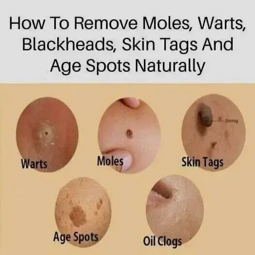 Acne Pimple All Skin Treatment and Formula